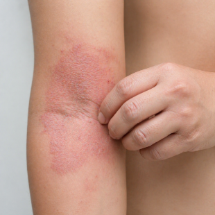 Skin Condition